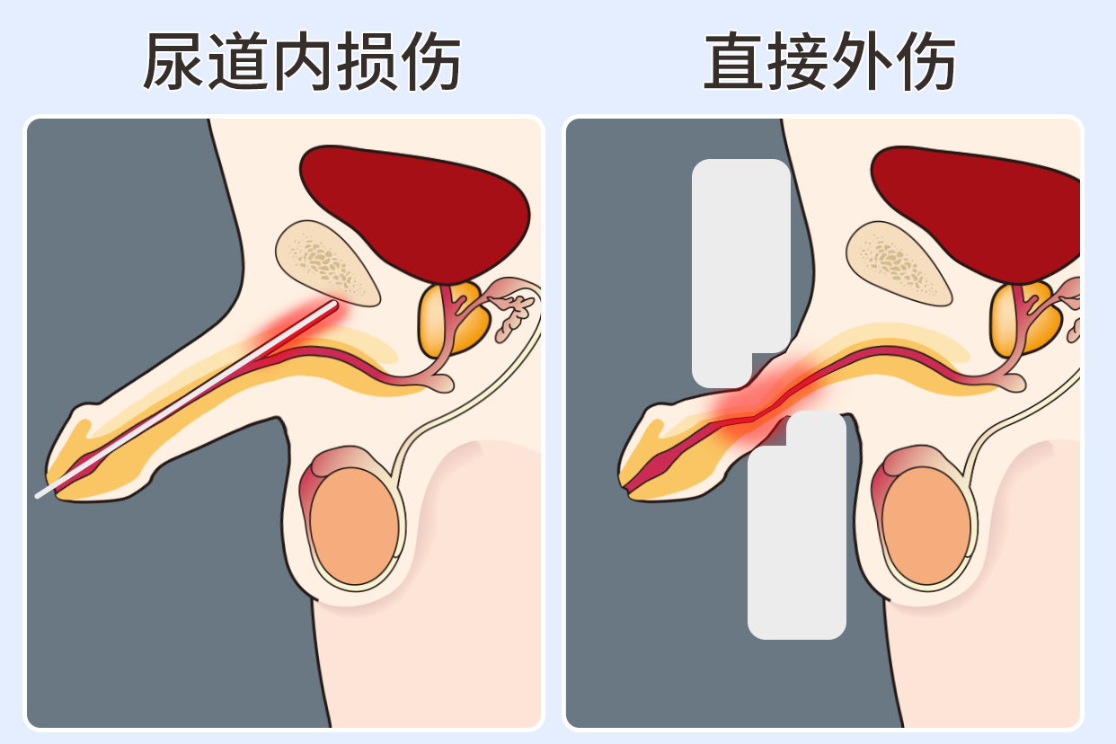 尿道损伤解剖图