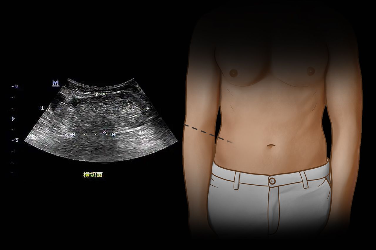 腹壁疝彩超报告图片