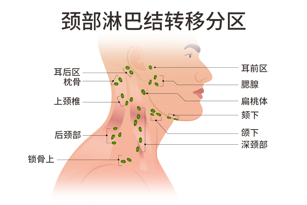 颈部淋巴结转移图片