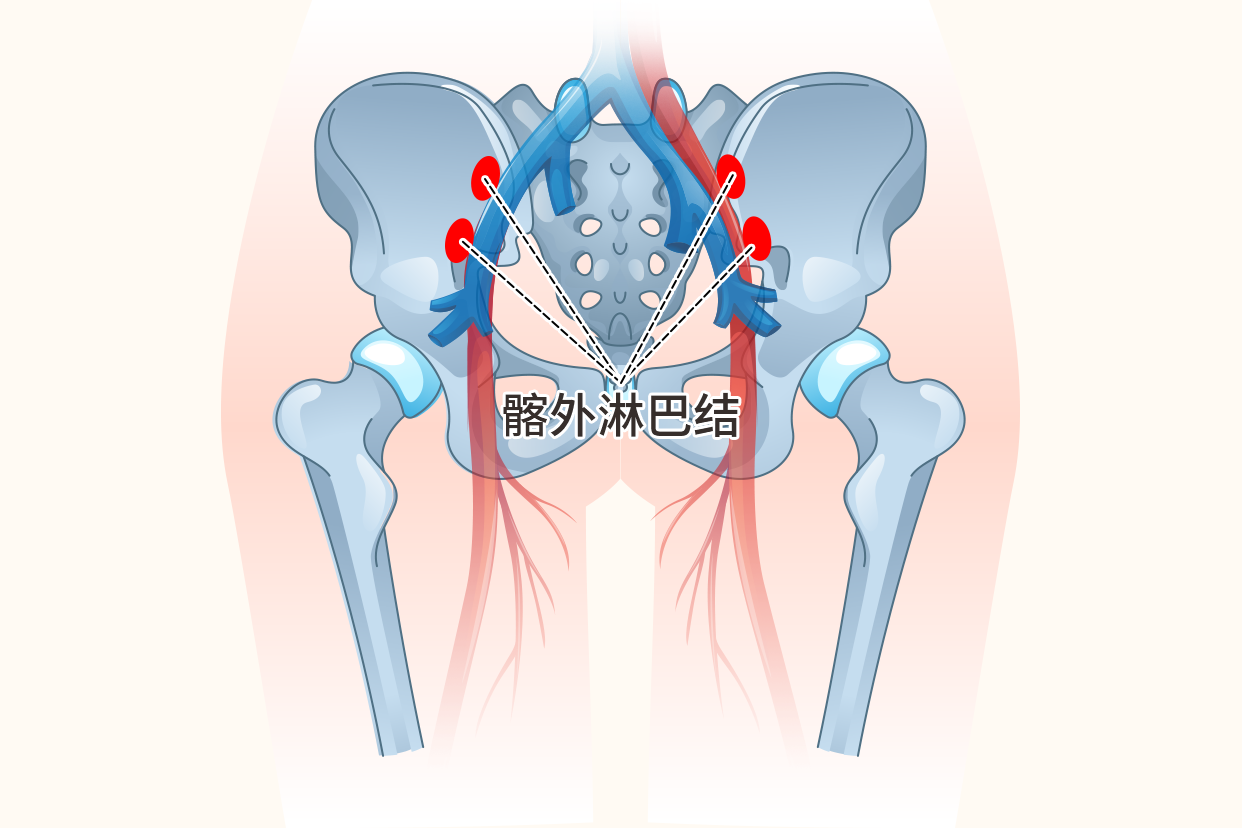 髂外淋巴结位置图