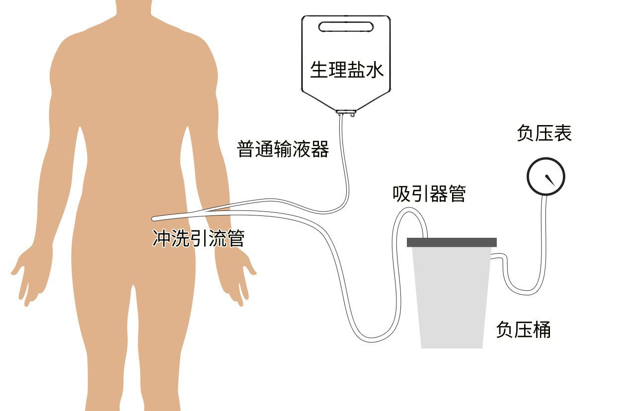 腹腔双套管灌洗引流图片