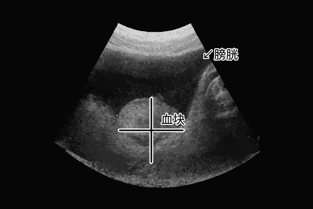 膀胱内血块超声图片