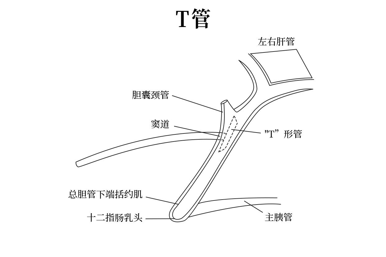 t管拔出后窦道形成图