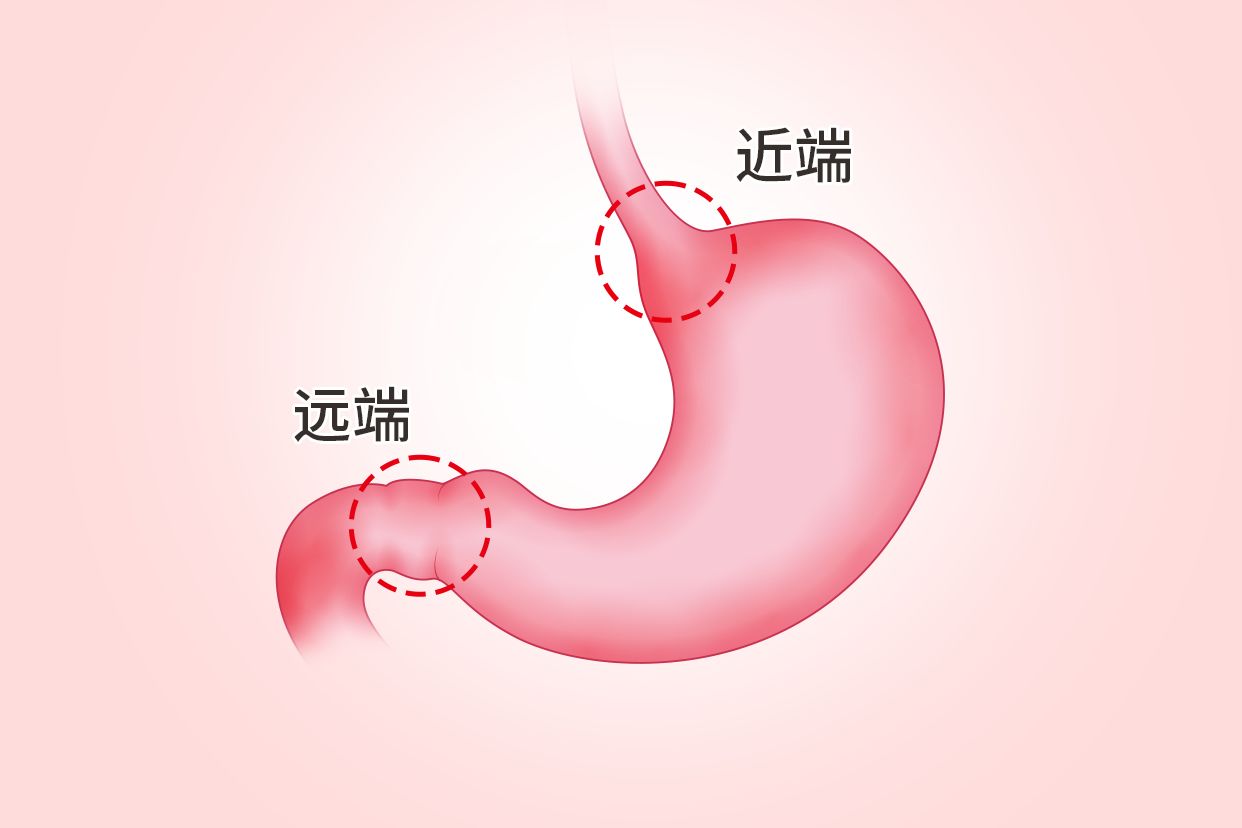 胃远端与近端的区别图（胃近端和远端）