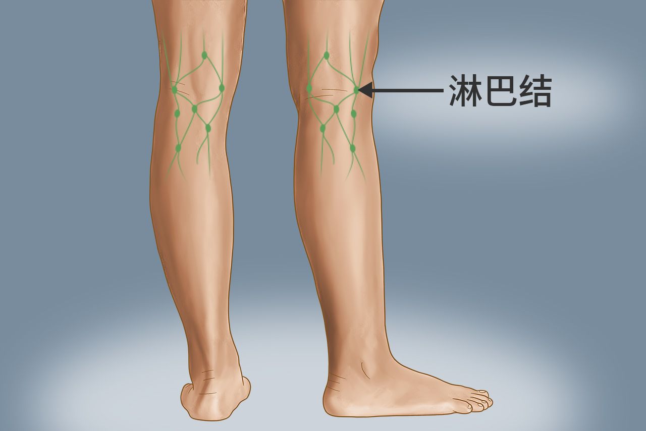 腿部腘窝淋巴结位置图片 腘窝淋巴结的位置图片