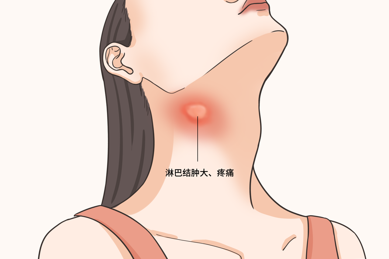 女性右侧颈部淋巴结肿大图片 左侧颈部淋巴结肿大图