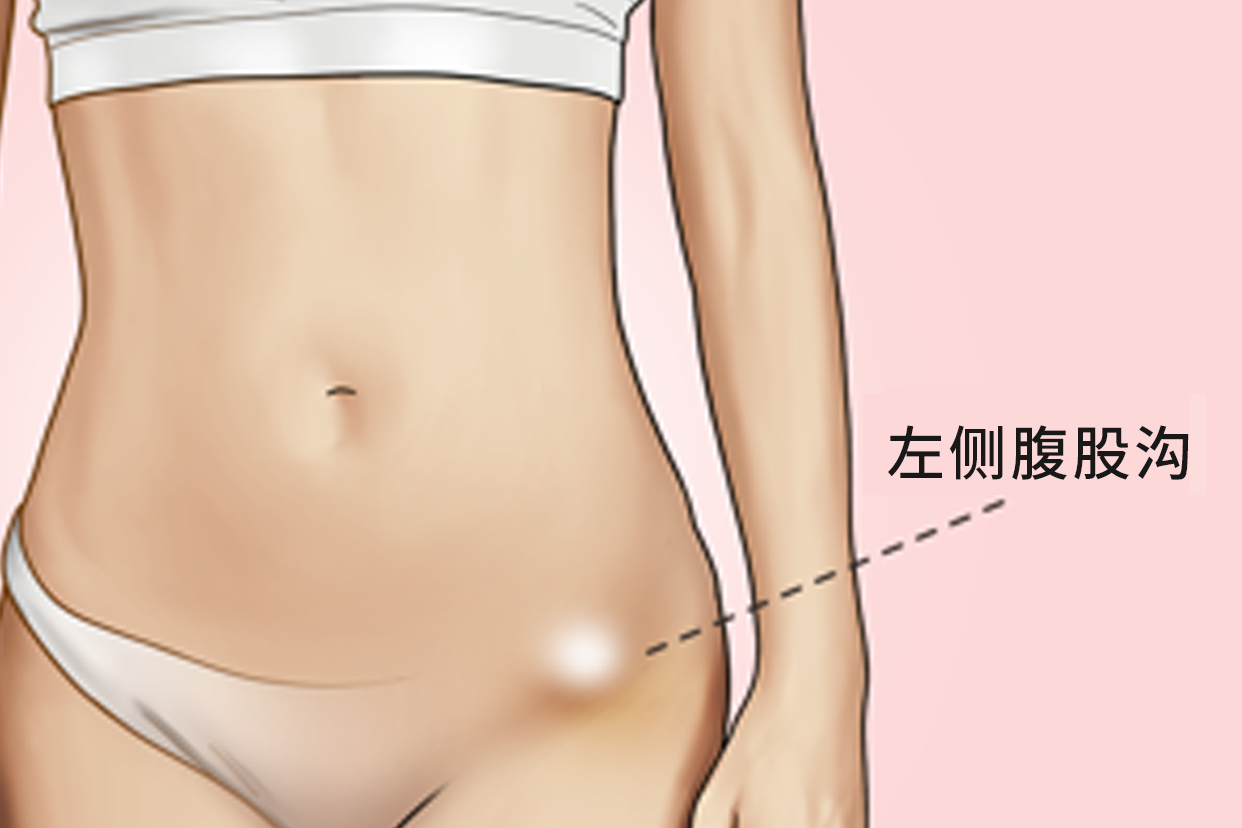 左侧腹股沟位置图（左侧腹股沟位置图片女性）