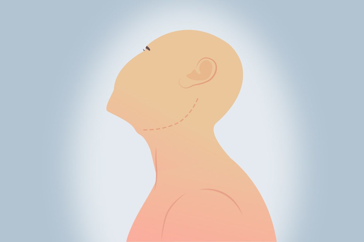 颈部手术切口方向图 颈部手术切口图片