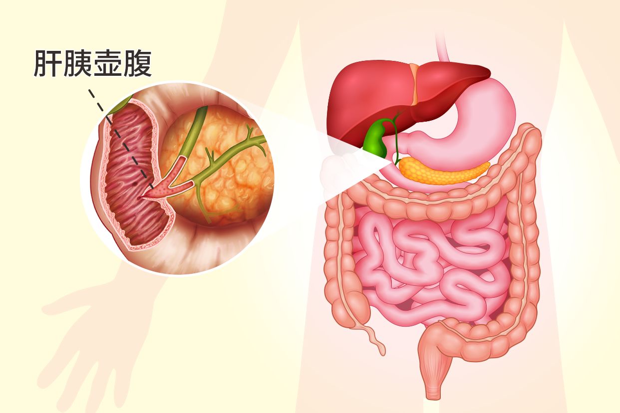 肝胰壶腹部在哪个位置图片（壶腹部在哪个位置图片胰腺）