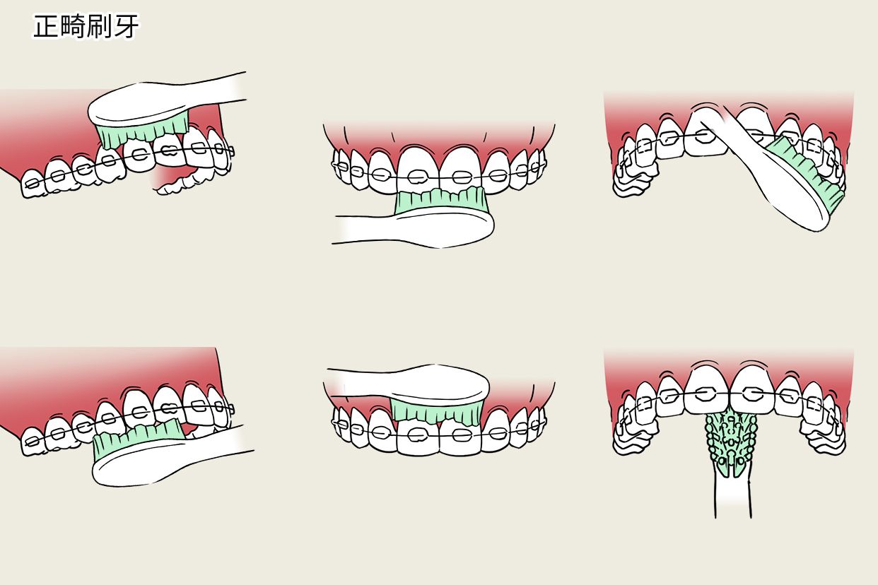 正畸刷牙步骤图片（矫正牙齿的牙刷图片）