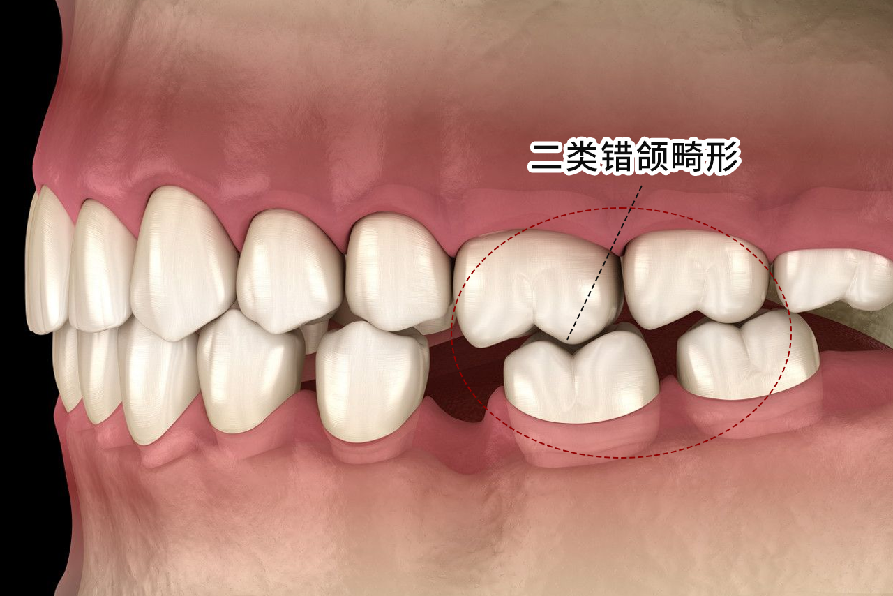 二类错颌畸形图片 三类错颌畸形