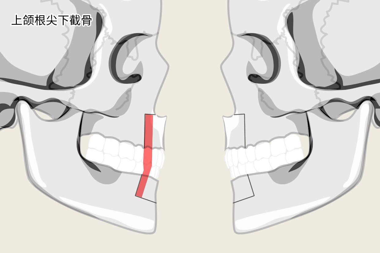 上颌根尖下截骨示意图（上颌前部截骨）