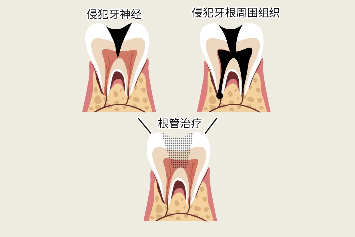 牙烂到什么程度要根管治疗图片（牙烂到什么程度要根管治疗图片视频）