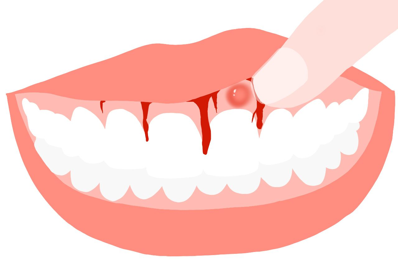 慢性重金属中毒牙龈图（牙龈重金属中毒症状）