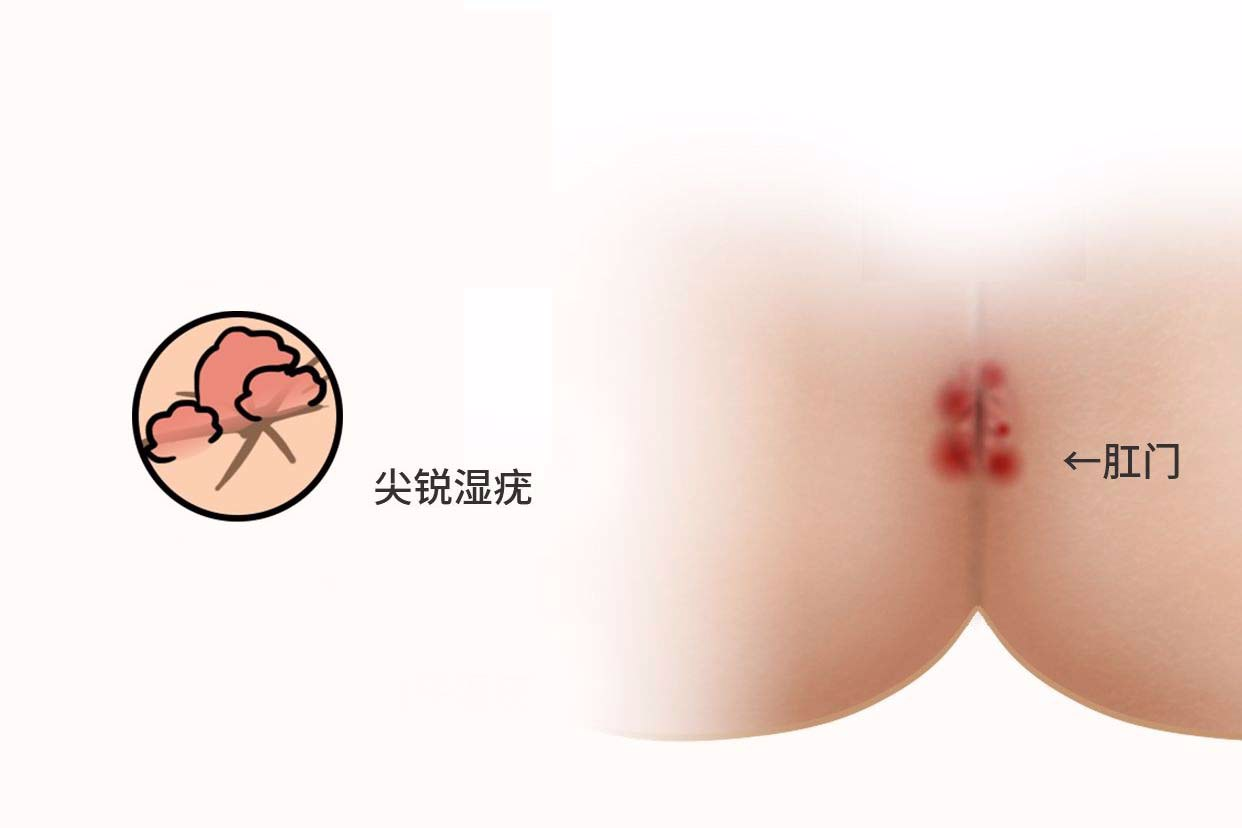 肛门尖锐湿疣图片（男性湿锐疣初期图）
