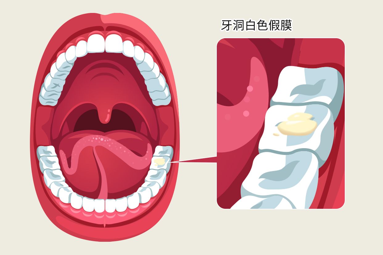 牙洞白色假膜图片 牙洞白色假膜图片