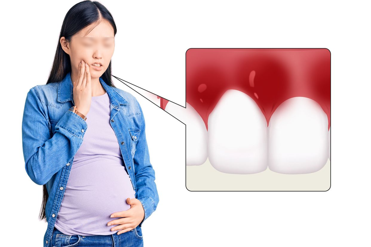 妊娠期牙龈炎图片 妊娠期牙龈炎图片溃疡假膜