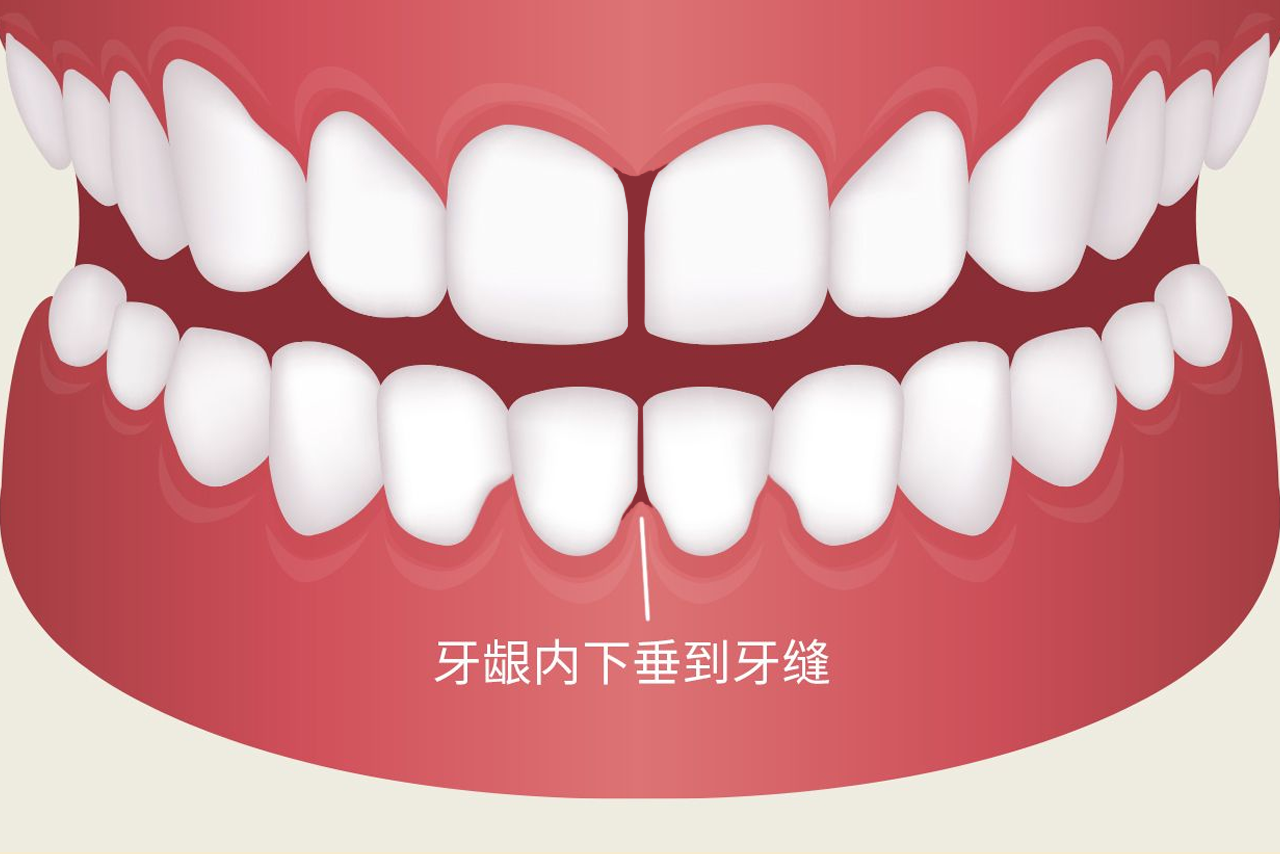 牙龈内下垂到牙缝是什么引起的图片 牙龈内下垂到牙缝是什么引起的图片