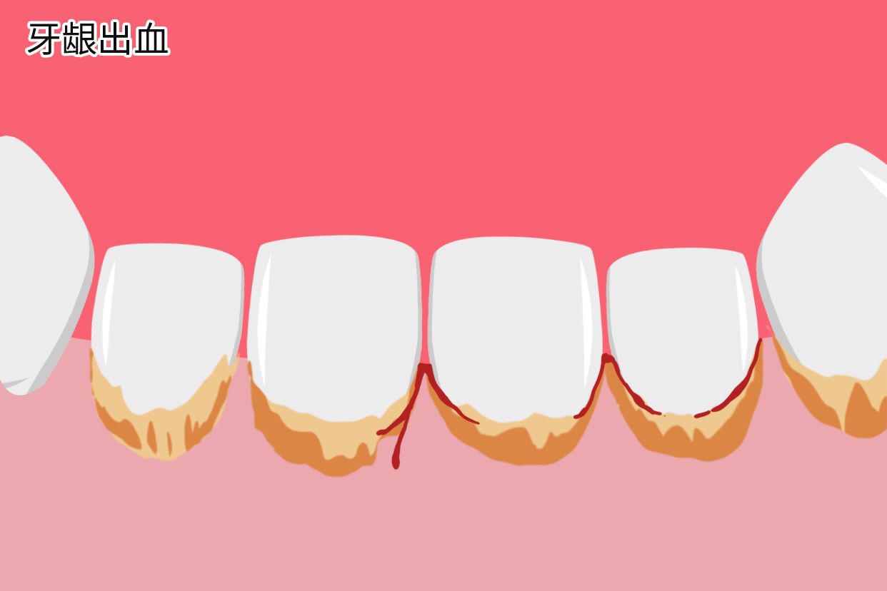 牙结石会导致牙龈出血吗图片（有牙结石牙龈会出血吗）