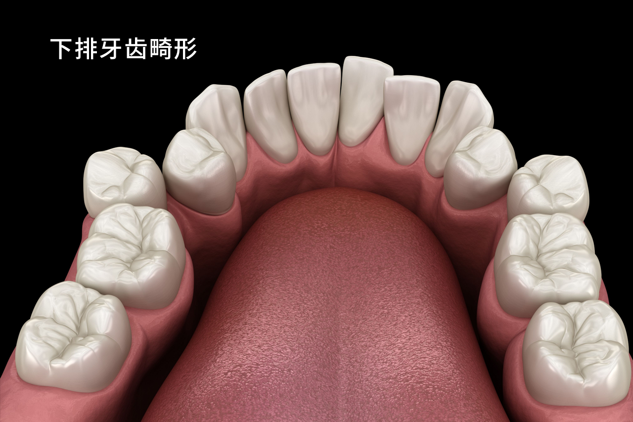 下排牙齿畸形图（下排牙齿畸形图解）