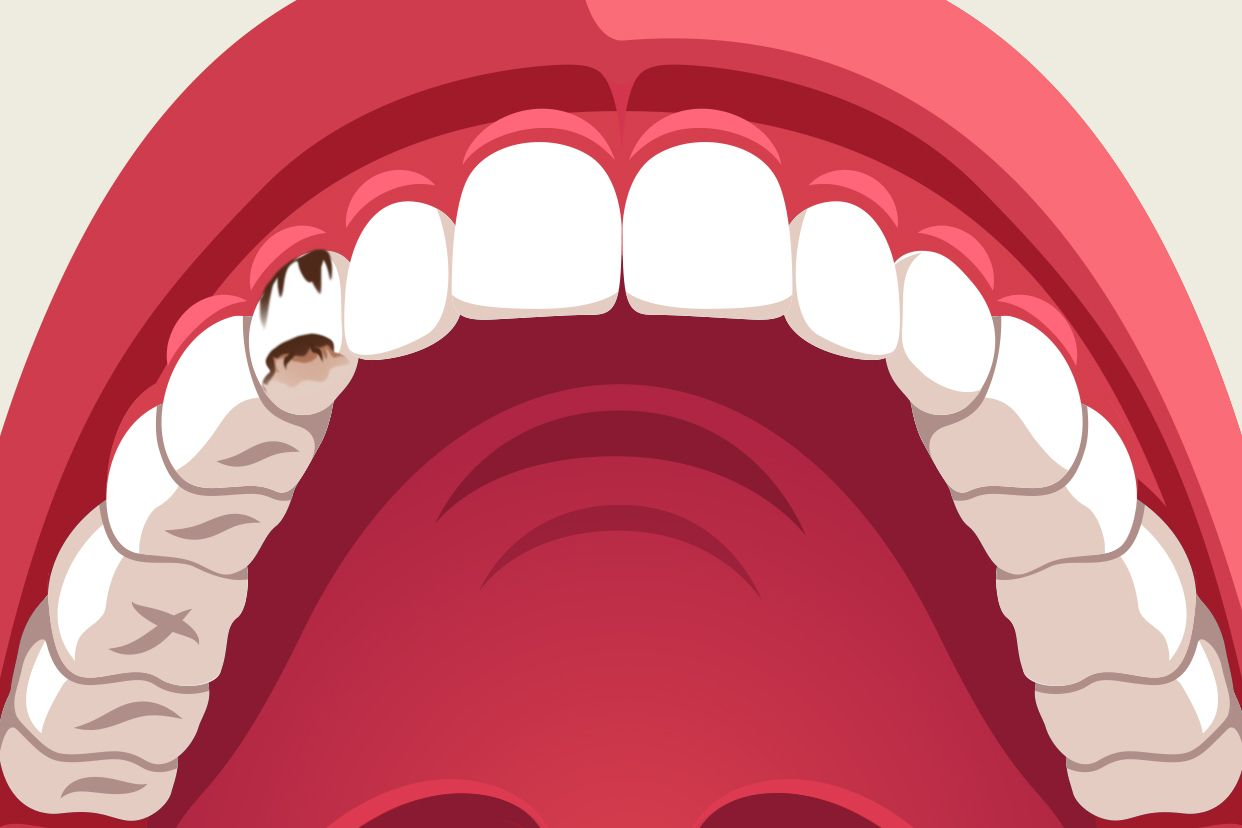 尖牙蛀牙图片 牙齿蛀牙图片