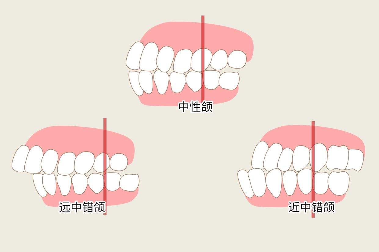 angle错颌分类图解（angle三类错颌）