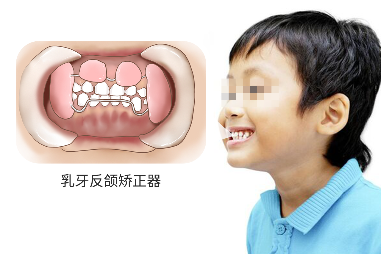 乳牙反颌矫正器图片 牙齿反颌矫正器