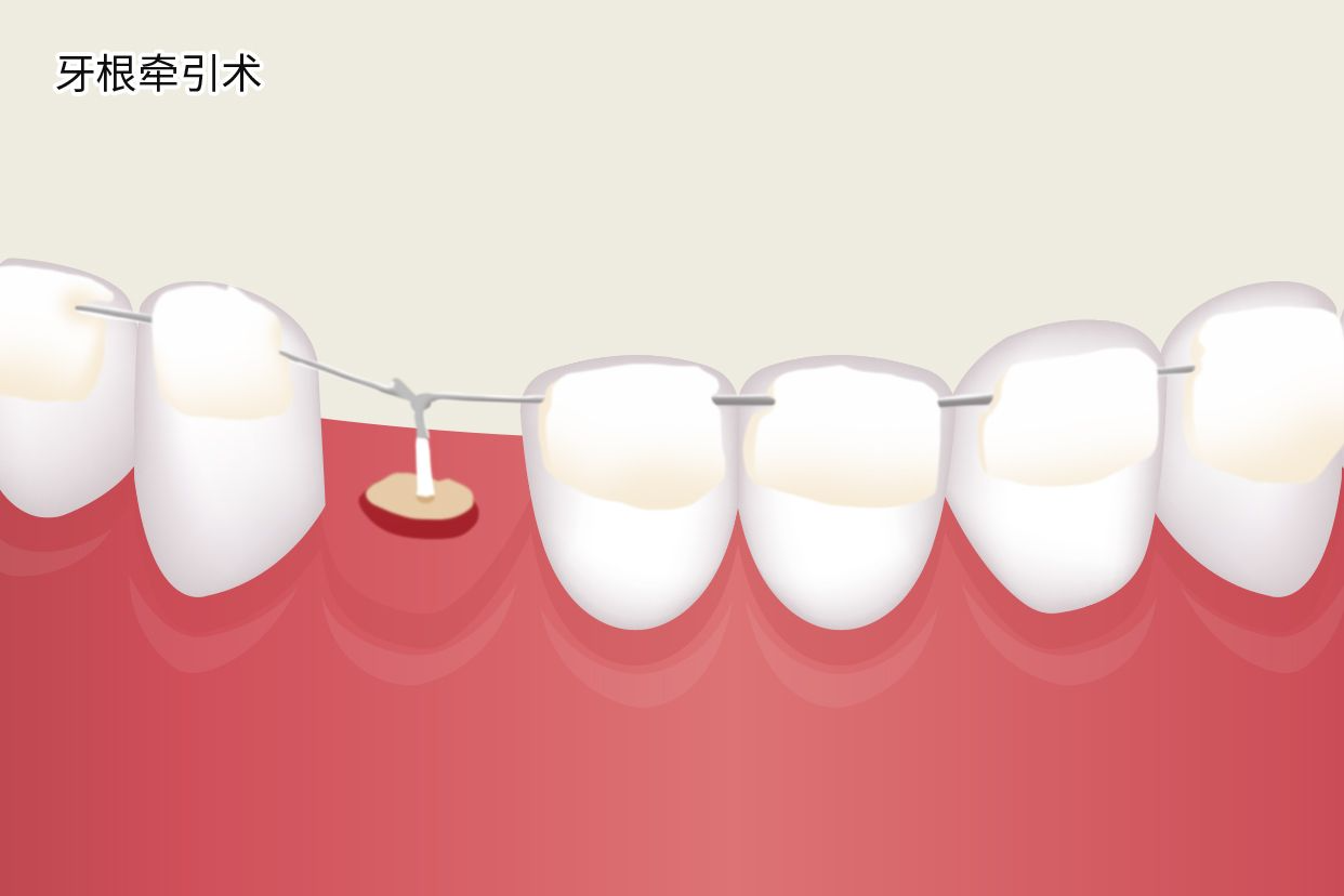 牙根牵引术图解 牙牵引手术图