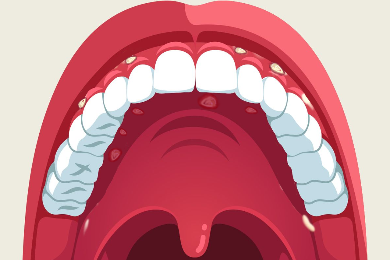 牙龈两侧溃疡图片（牙龈内侧溃疡图片）