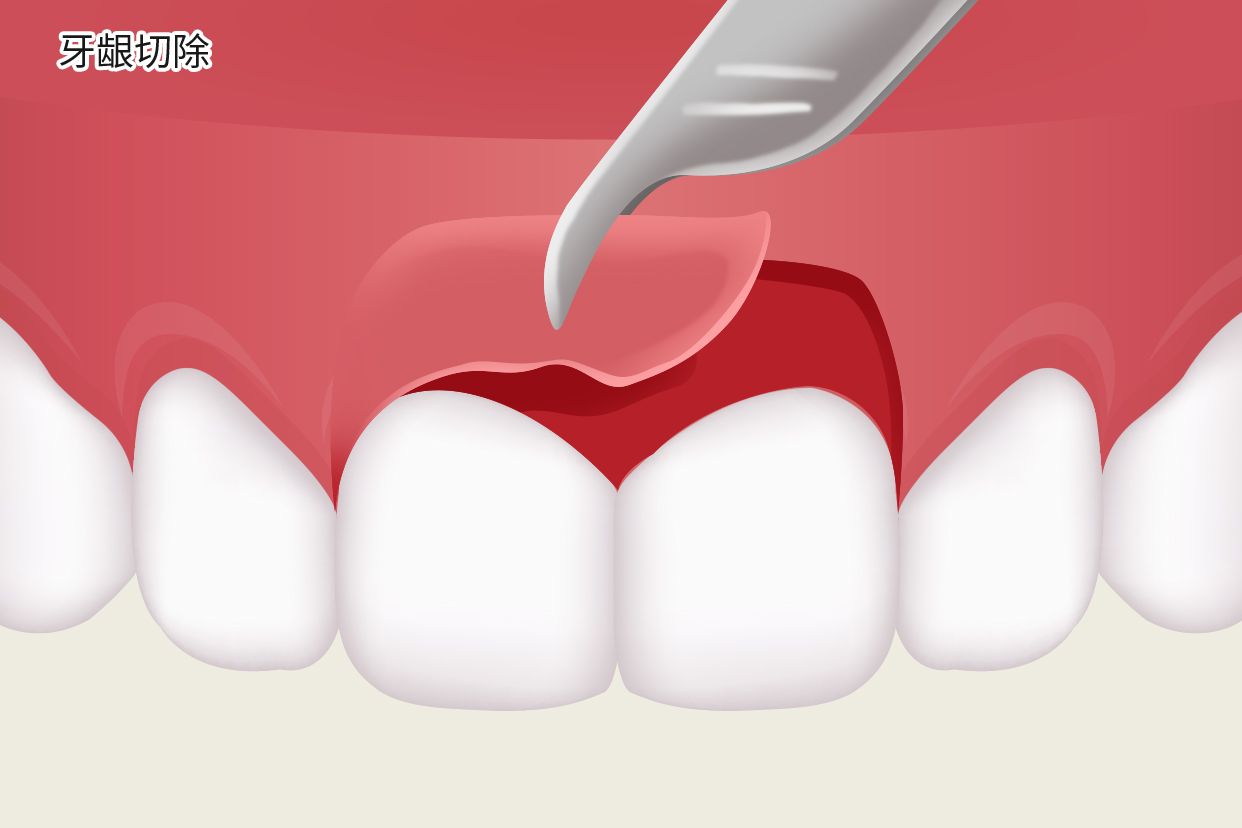 牙龈切掉能长吗图片 牙龈切掉了还能长吗