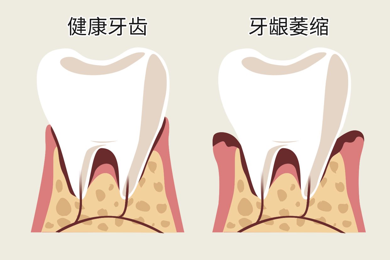 单个牙龈萎缩图片（单个牙龈萎缩图片高清）