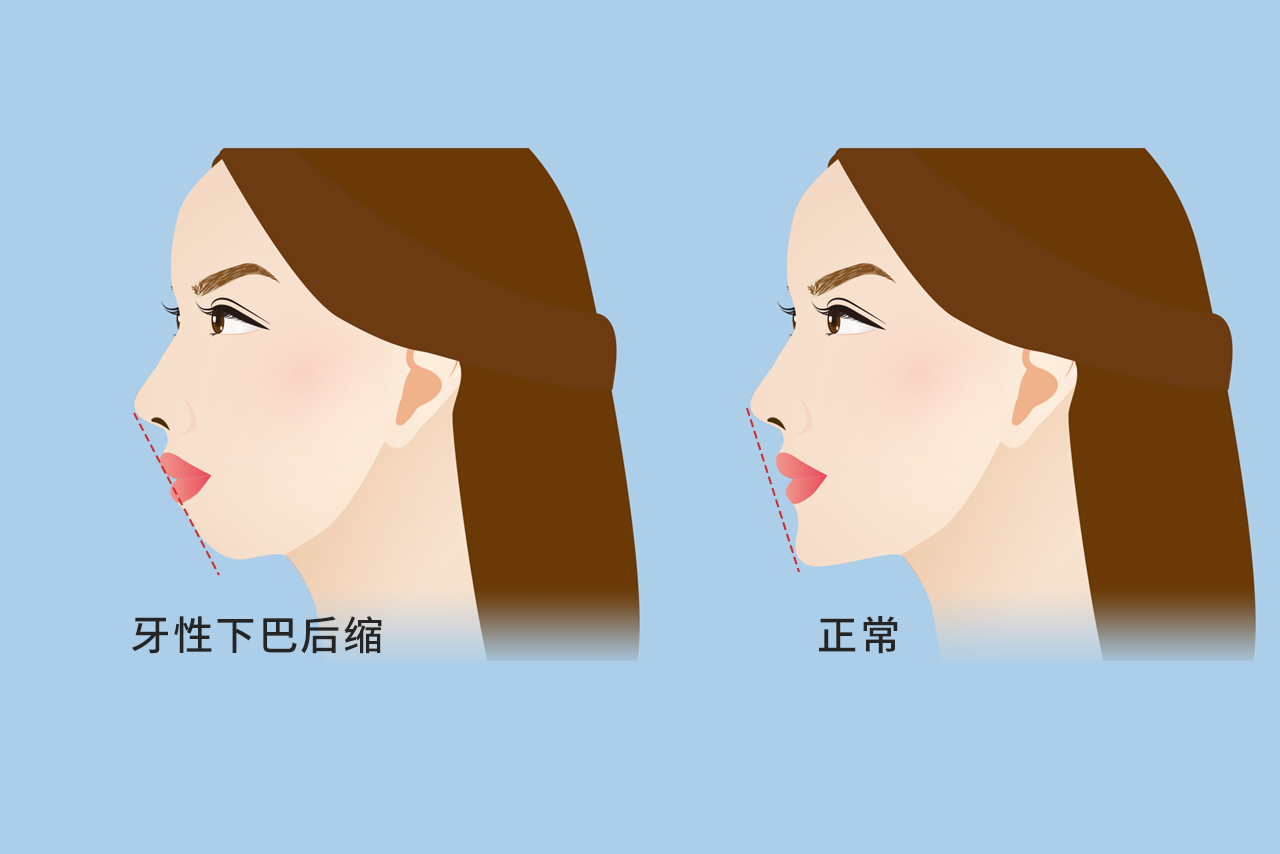 牙性下巴后缩图片（牙性下巴后缩和骨性下巴后缩）