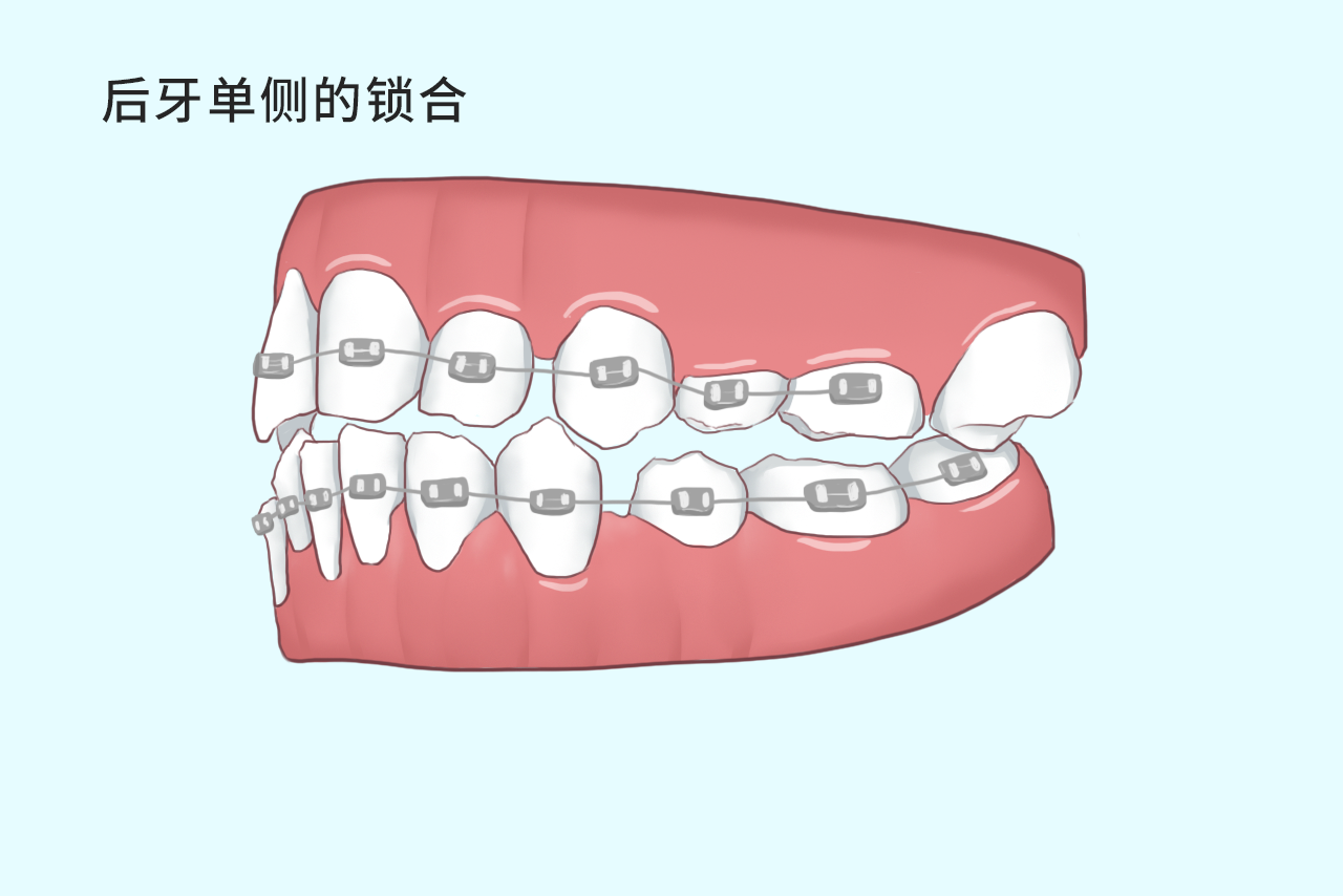 后牙单侧的锁合如何矫正图片 双侧后牙锁合