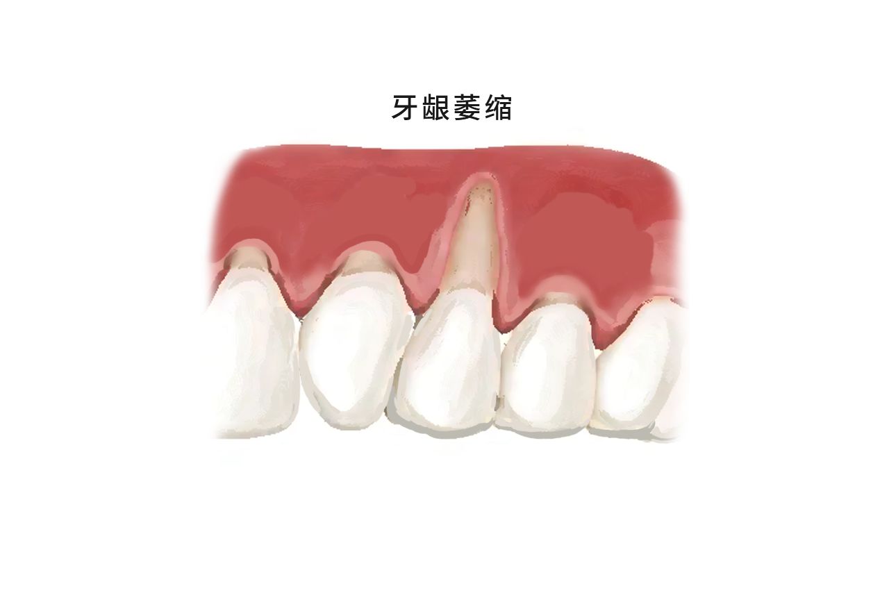 戴牙套牙龈萎缩图片（带牙套牙龈萎缩图片）