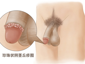 冠状沟皮脂腺异位图片（颊粘膜异位皮脂腺图片）