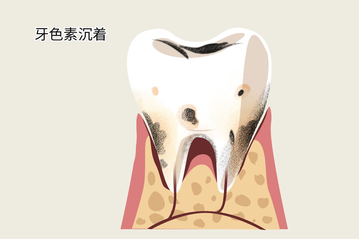 牙色素沉着和龋齿区别有图吗（牙齿色素沉着和龋齿区别）