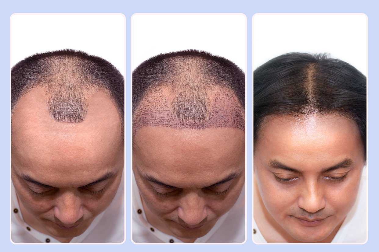 植发密度55和原生发密度的区别图片 植发密度55和原生发密度的区别图片