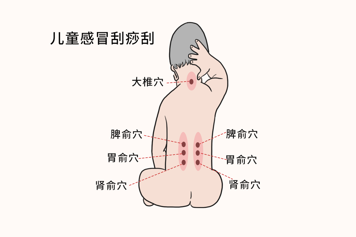 儿童感冒刮痧刮哪里图解 小孩感冒刮痧刮哪里图解