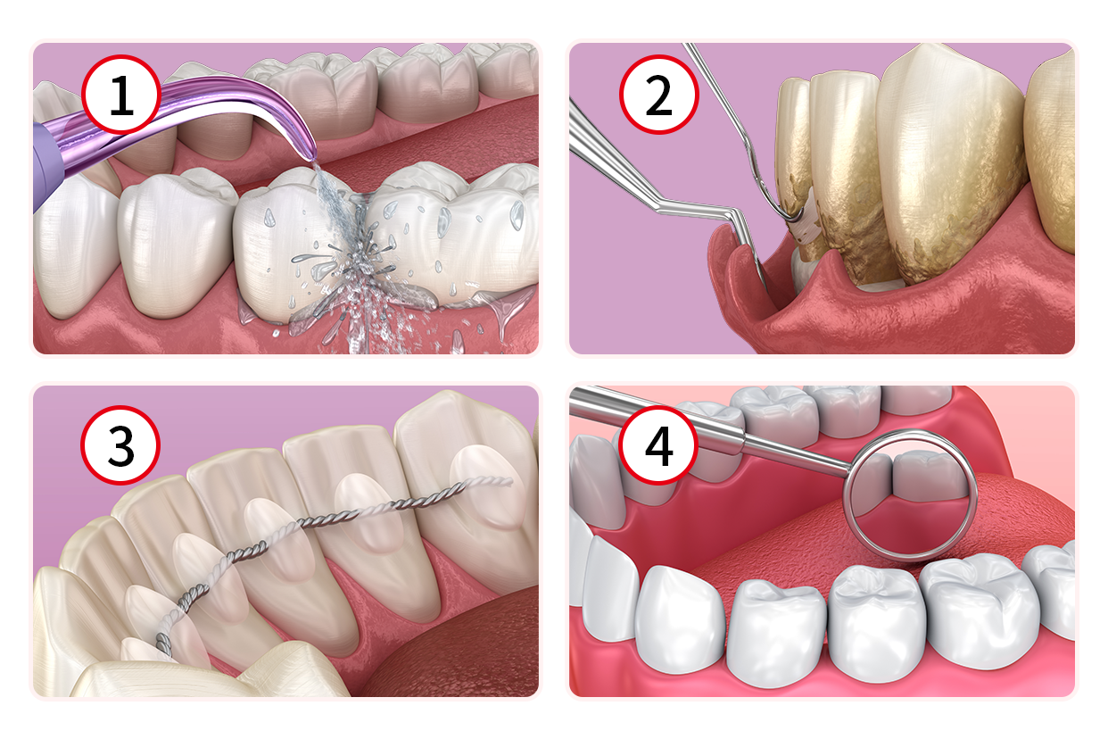 牙周治疗四个步骤图解（牙周治疗操作要点）