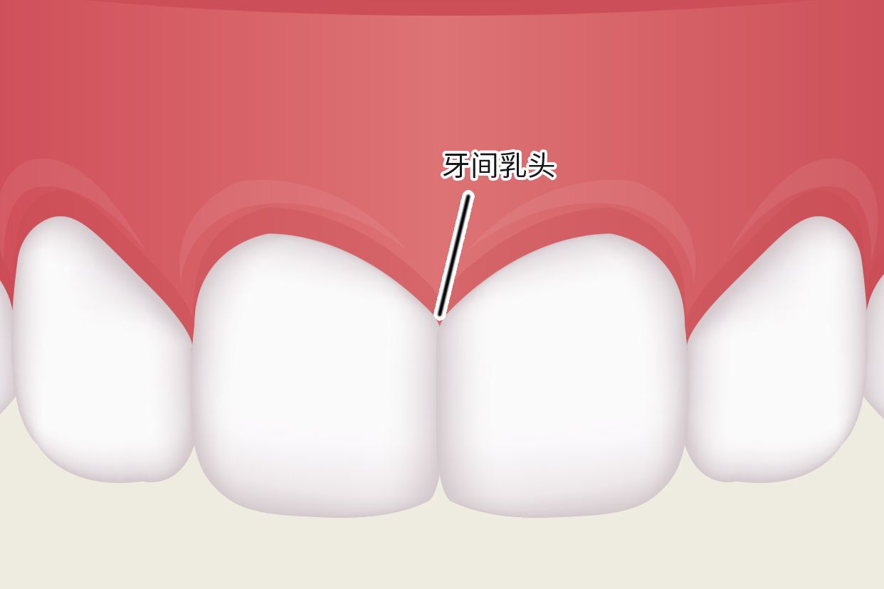 牙龈乳头图片（乳牙长在牙龈里面图片）