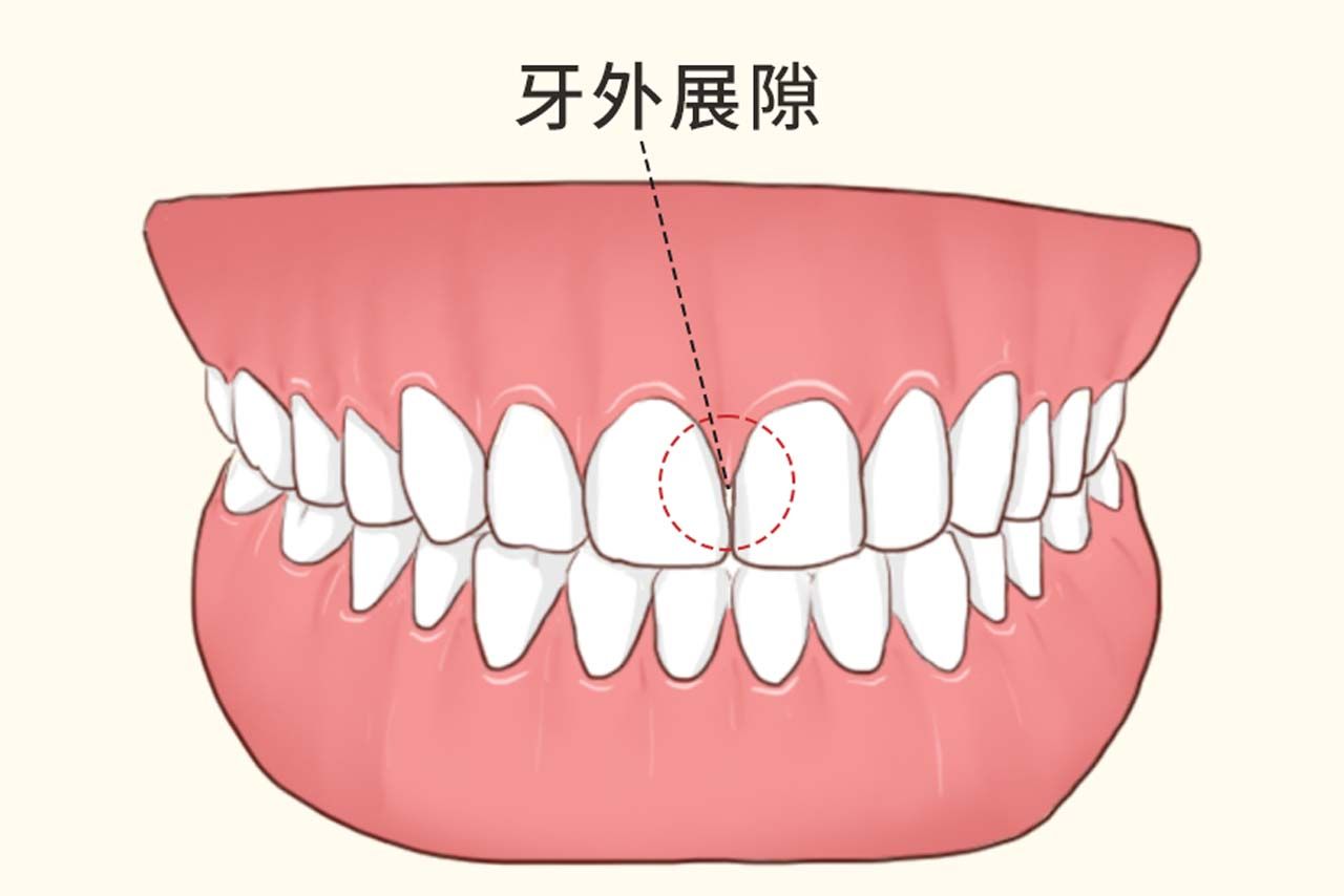牙外展隙图解（牙齿邻间隙和外展隙）
