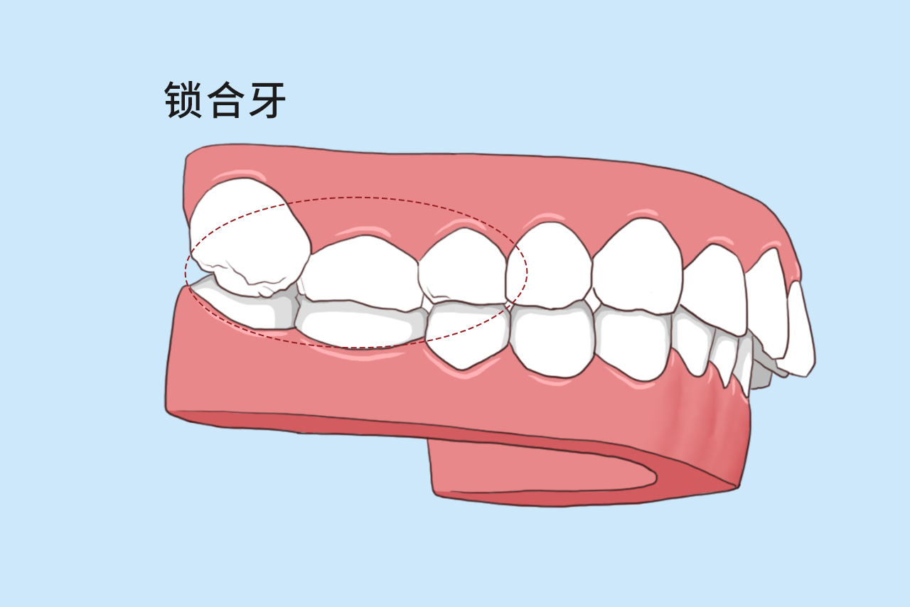 锁合牙图片（牙齿反锁合图片）