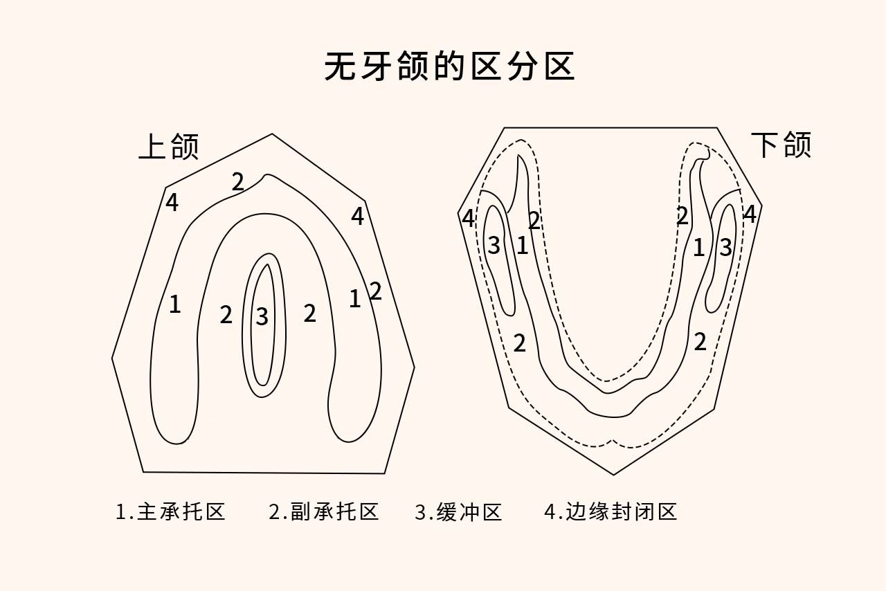 全口义齿无牙颌分区图