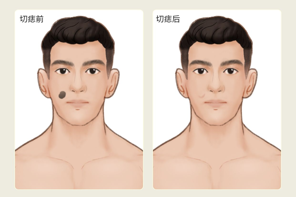 切痣前后对比照片