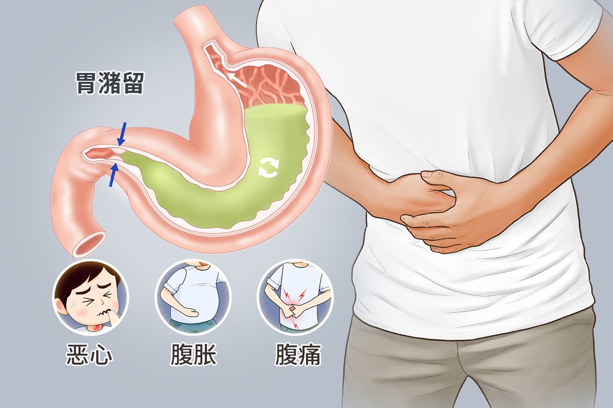 胃潴留图片