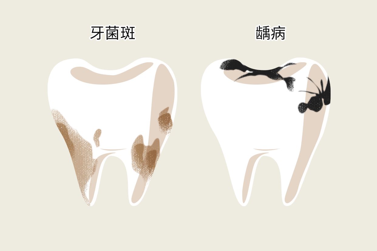 牙垢和蛀牙的区别图片
