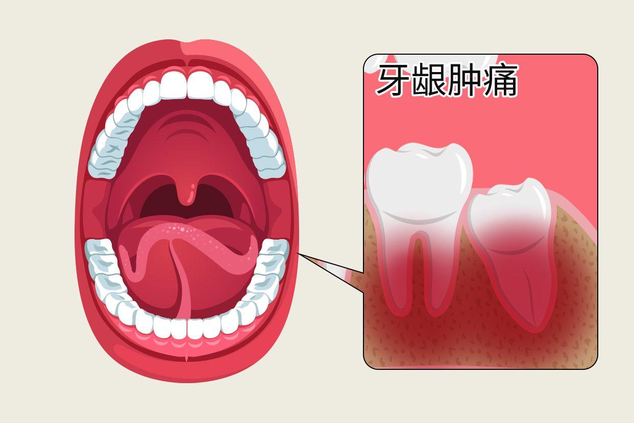 最里面的牙龈肿痛图片