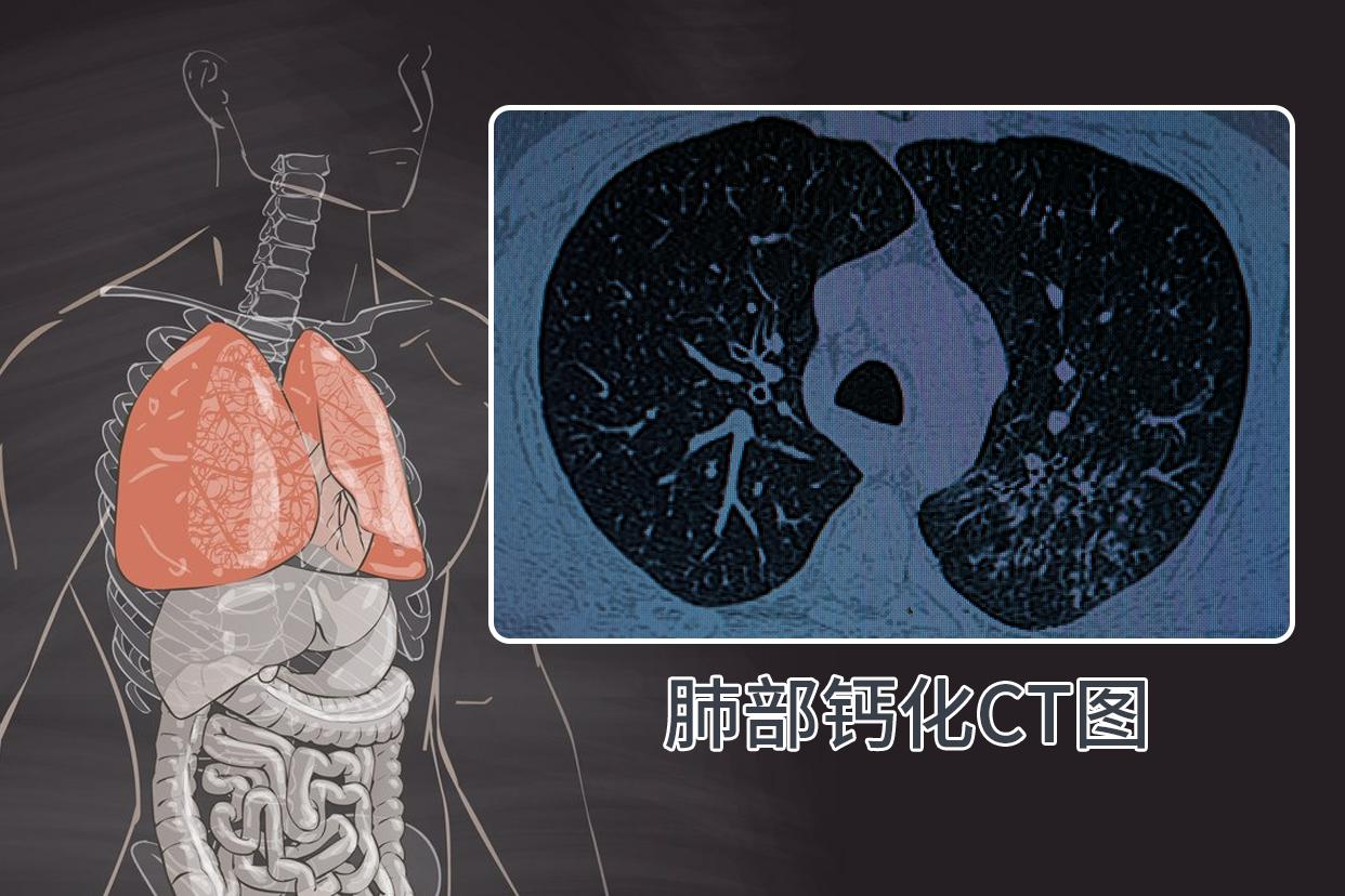 肺部钙化ct图像啥样的（肺部钙化ct图像啥样的）