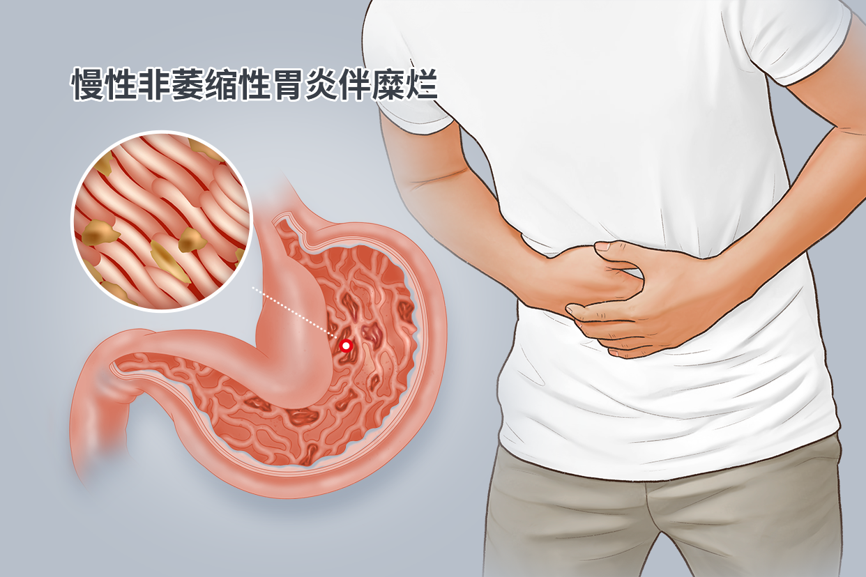 慢性非萎缩性胃炎伴糜烂图片 慢性非萎缩性胃炎伴糜烂图片大全