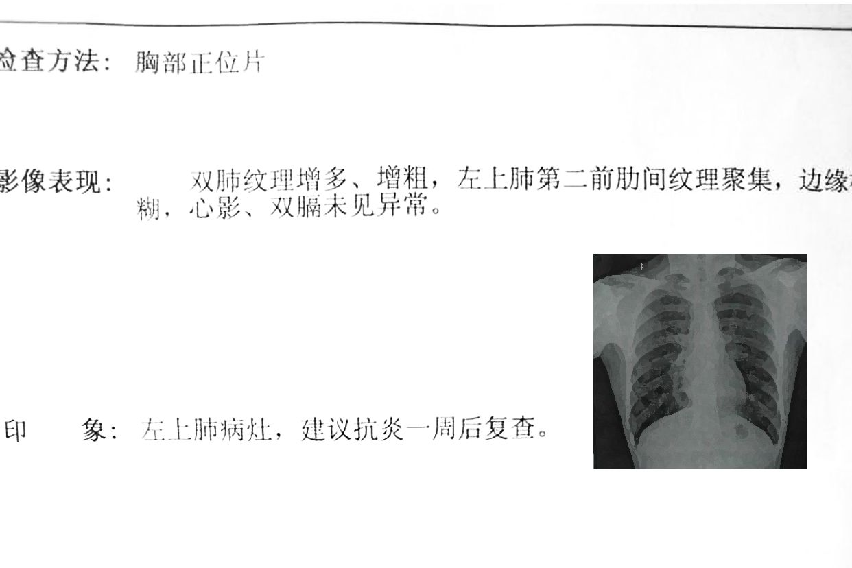不正常的胸片图和报告 不正常的胸部ct影像图片
